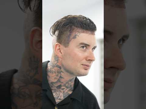 Unshaved Hair Transplant ~Long Hair Center