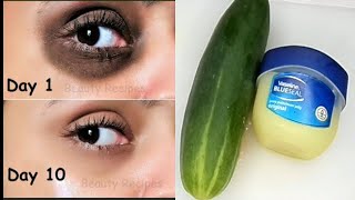 how to remove dark under eyes in 5 days