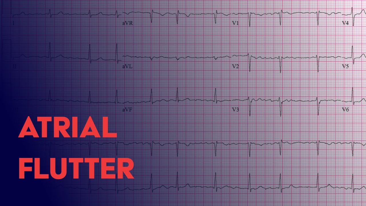 Atrial Flutter -  EKG (ECG) Interpretation