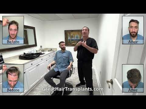  Dr. Brett Bolton Patient Mike, another Failed FUE Correction MaxHarvest&trade; Plus 

