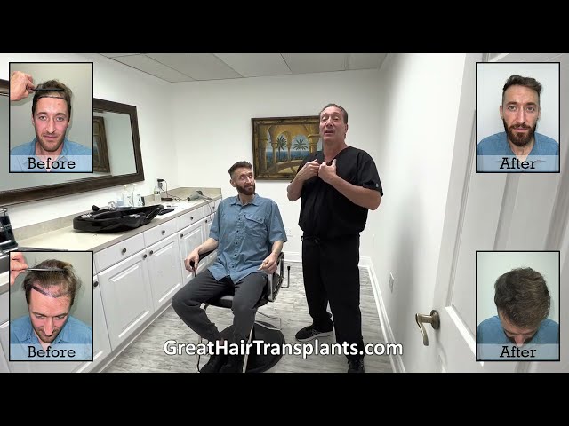  Dr. Brett Bolton Patient Mike, another Failed FUE Correction MaxHarvest&trade; Plus 

