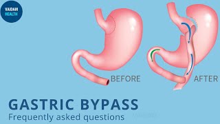 Gastric Bypass - Frequently Asked Questions