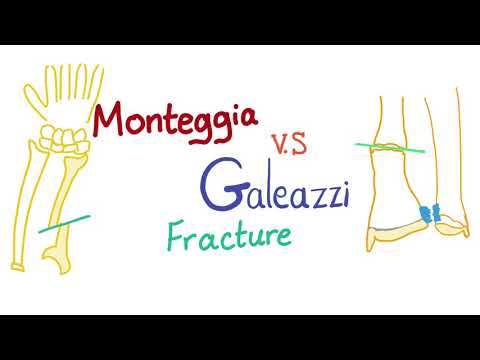 Monteggia vs. Galeazzi fracture - Orthopedic surgery