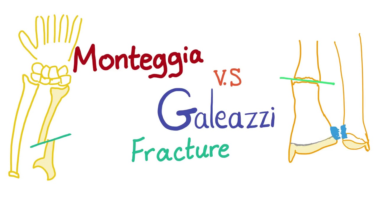 Monteggia vs. Galeazzi fracture - Orthopedic surgery