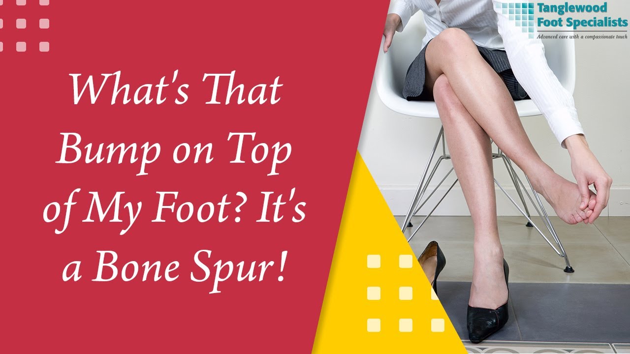 What's That Bump on Top of My Foot? It's a Bone Spur!