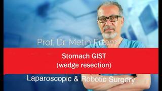 Miniaturka - Stomach GIST, wedge resection. Metin Ertem MD.FACS