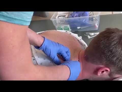 Intramuscular Stimulation