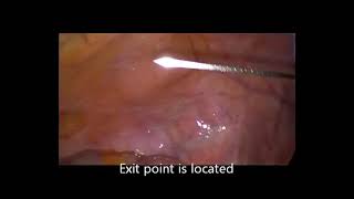 TPEA Lifter - Recto Vaginal Prolapse