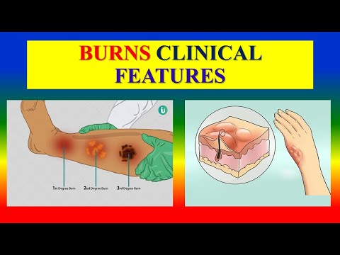 BURNS - Clinical Features