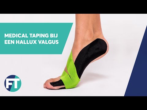 hallux valgus tapen | Medical Taping | FysioTape