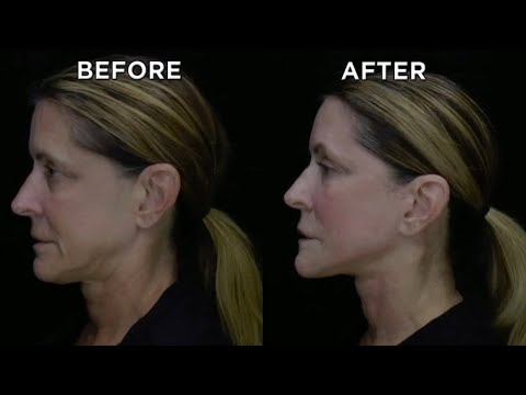 Unbelievable Before and Afters of Neck Lift!