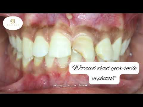 Pre-Bridal Smile Makeover for Your Dream Wedding