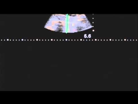Lung Ultrasound M Mode with Pneumothorax