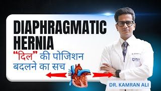 Diaphragmatic Hernia Explained | दिल की पोजिशन बदलने का सच जानिए! | Dr Kamran Ali (Hindi)