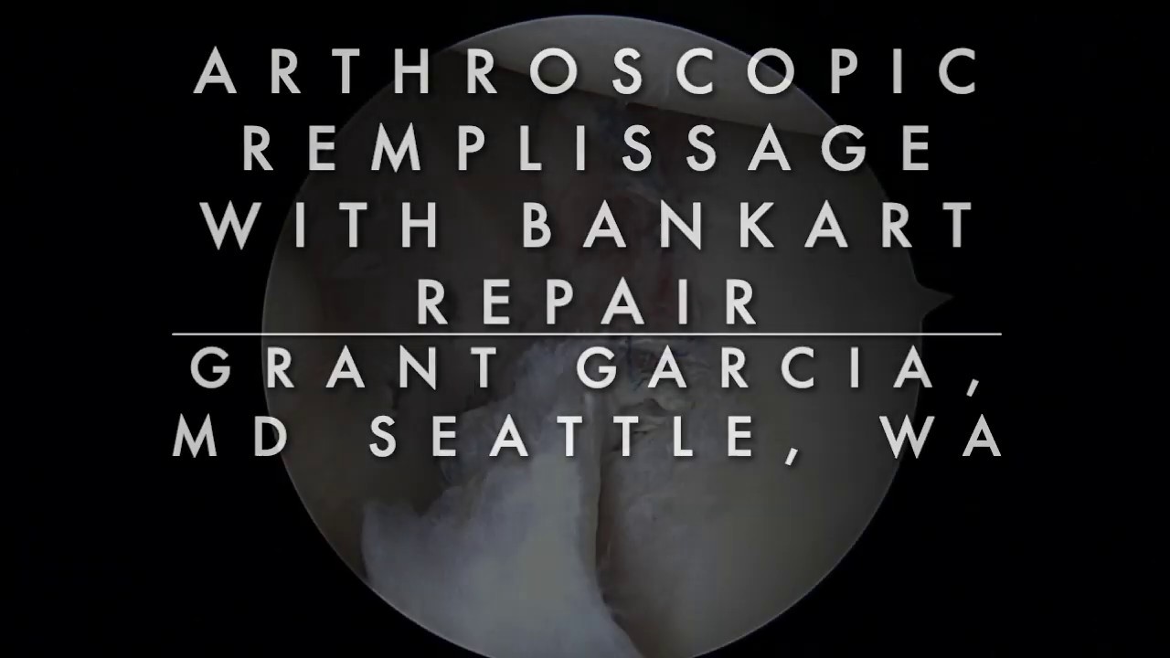 Dr. Garcia demonstrates his arthroscopic remplissage technique