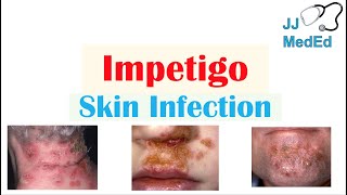 Introduction to Impetigo | Infection, Subtypes and Treatment