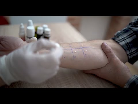 What is Skin Prick Testing?