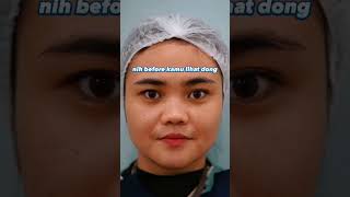 Download lagu FILLER HIDUNG #youtubeshorts #shortsvideo #youtube #kecantikanwajah #fypシ #fyp mp3 Download lagu FILLER HIDUNG #youtubeshorts #shortsvideo #youtube #kecantikanwajah #fypシ #fyp mp3