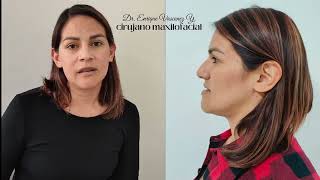 Testimonio Cirugía Ortognatica antes y después