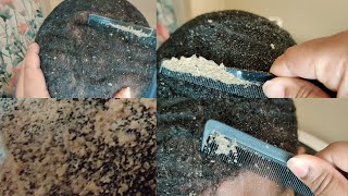 The Best Of the Itchy Scalp | Dandruff Compilation Pt. 9