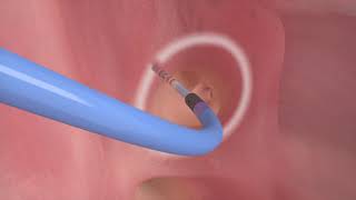 Catheter Ablation Animation