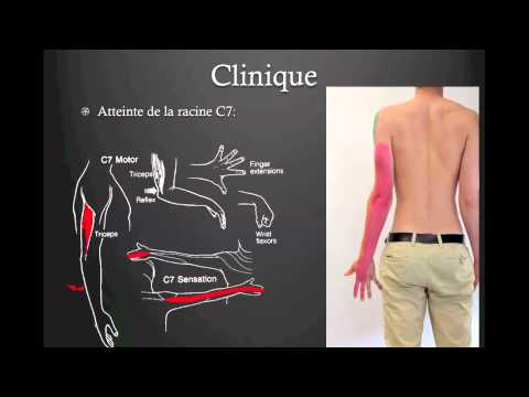 comment guerir nevralgie cervico brachiale