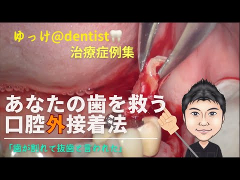 生命歯学科 ゆっけ＠dentist🦷治療症例集　口腔外接着法　「歯が割れてしまって抜歯しかない」そう言われた方必見！歯を保存するための接着治療とは