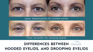 Differences in Treating Hooded Eyelids, and Drooping Eyelids Caused by Ptosis