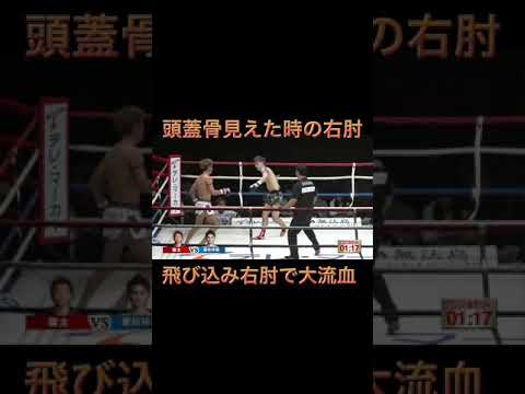 現役生活の中で頭蓋骨が見えた肘もらったの2回目。