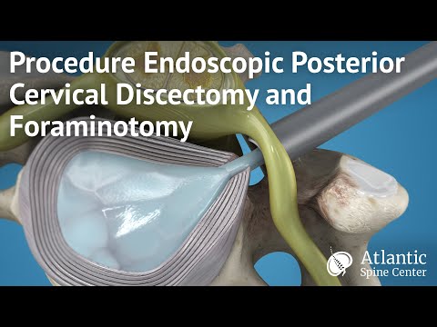 Endoscopic Posterior Cervical Discectomy and Foraminotomy