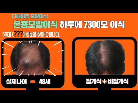 모발이식 하루에 7300모 절개 비절개 혼용모발이식으로 청춘을 돌려주는 디에이징모발이식