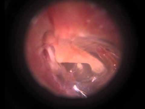 Zespół ziejącej trąbki słuchowej