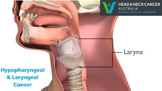 Hypopharyngeal & Laryngeal Cancer (throat) - W