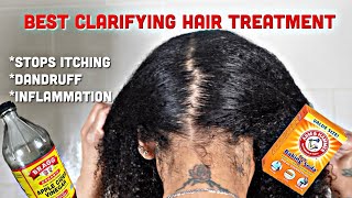 HOW TO GET RID OF ITCHY SCALP & PREVENT DANDRUFF| ACV & BAKING SODA TREATMENT