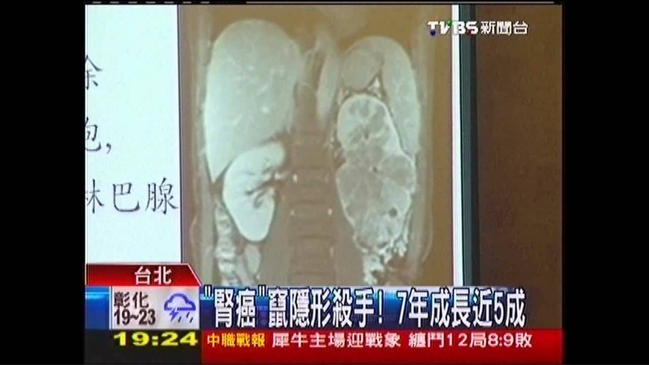 「腎癌」竄隱形殺手 7年成長近5成