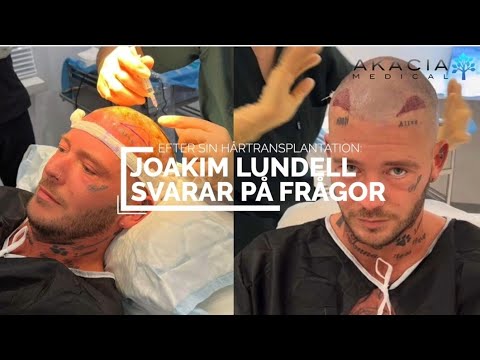 Joakim Lundell – Q&A efter hårtransplantation