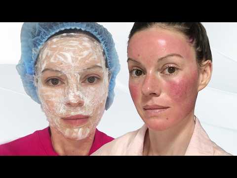 CO2 Fractional Laser Treatment in Thailand: Day by Day Recovery (Wks 1–3)