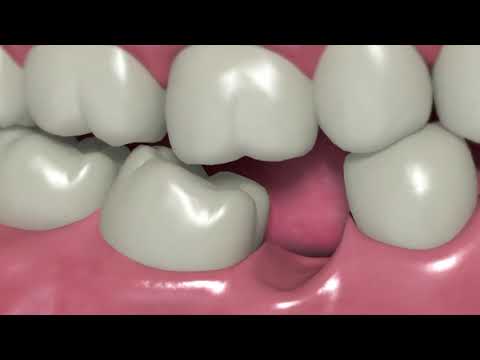 Dental Bone Loss - How does this occur?