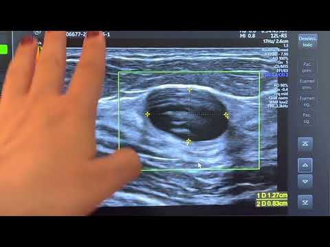 Distingue un Quiste de mama y un Fibroadenoma por ultrasonido