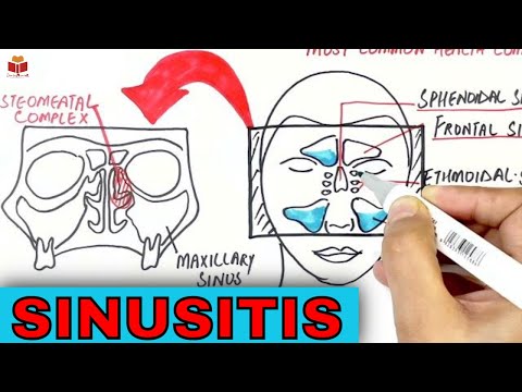 What is Sinusitis? | Causes, Symptoms & Treatment