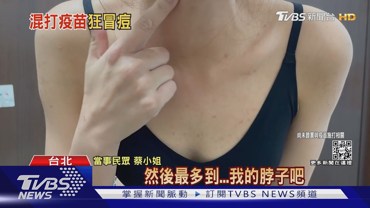 3劑混打!接種莫德納疫苗後 女「狂冒痘、發癢」半年