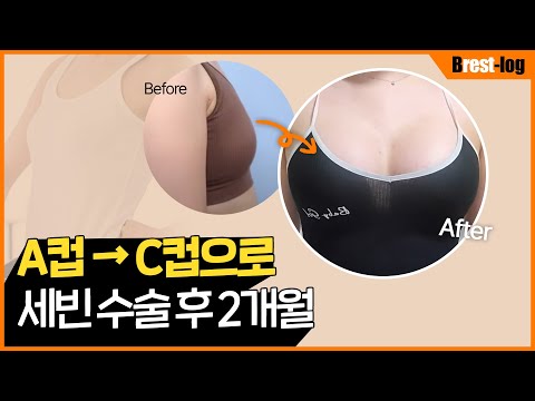 세빈 보형물을 선택한 이유는? | 가슴성형 2개월 | 가슴성형 C컵후기 | 촉감/통증/흉터/붓기 | 윈느성형외과 | 윈느성형외과 라벨윈느 유튜브 영상