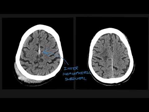 Understanding the different types of traumatic brain bleed on CT scans