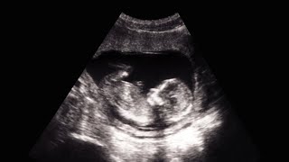 How Much Amniotic Fluid is in There? #shorts #pregnancy