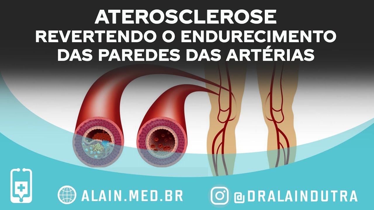 Aterosclerose, revertendo o endurecimento e a formação de placas nas paredes das artérias
