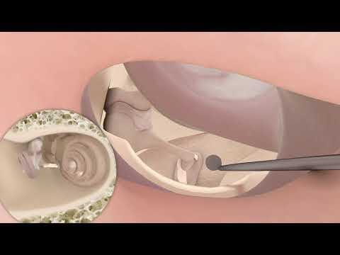 marLase Pro® | Stapedotomy for otosclerosis