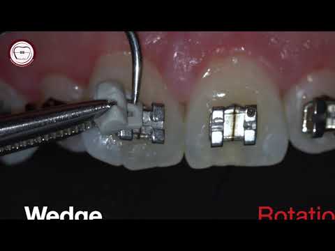 Rotational wedge in orthodontics by Amr Asker on apple store application