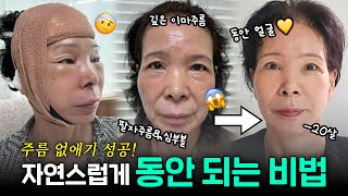 20년이나 젊어진 동안 비법 안면거상 리프팅 후기_[삼사오 성형외과]