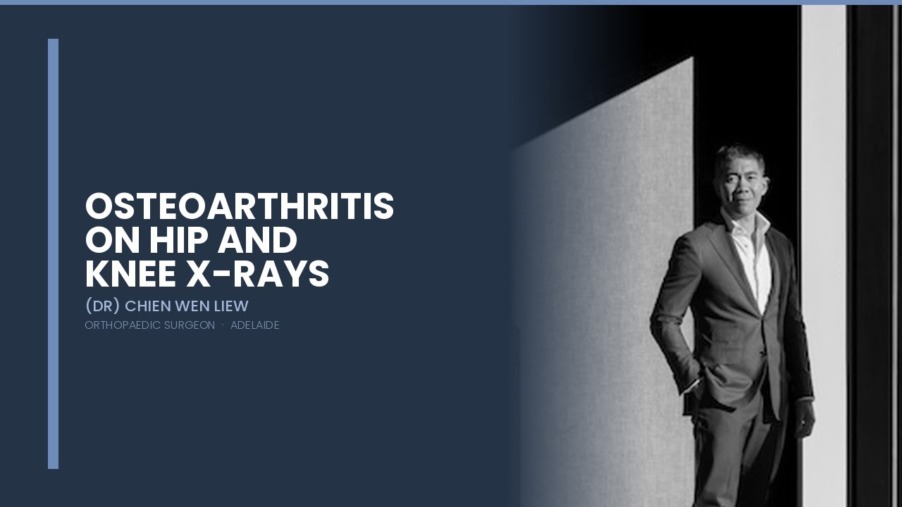 Dr Liew — Osteoarthritis on Hip and Knee Xrays