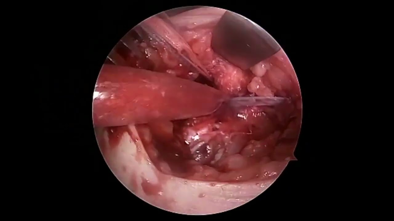 Fertilized ACL Using Quad Autograft